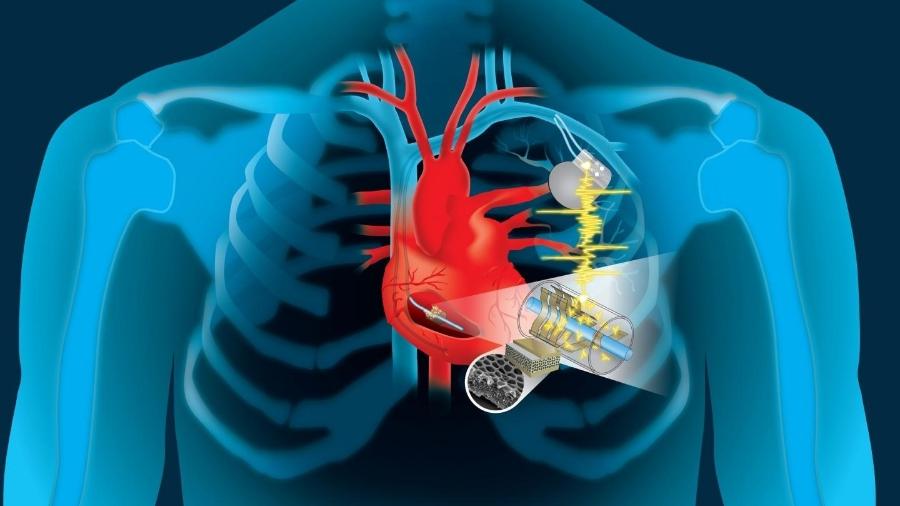 Ilustração do dispositivo criado por engenheiros do Dartmouth College para capturar energia do coração - Divulgação/Dartmouth College