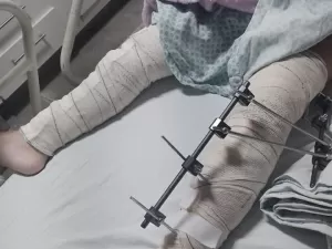 PB: Menina de 6 anos cai da bicicleta e tem pinos colocados em perna errada