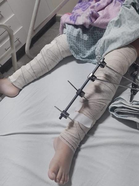 Menina com as duas pernas operadas após erro de hospital em Campina Grande