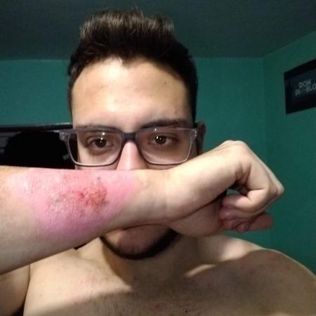 Argentino mostra hematoma no antebraço após usar ralador para remover tatuagem - Reprodução/Twitter