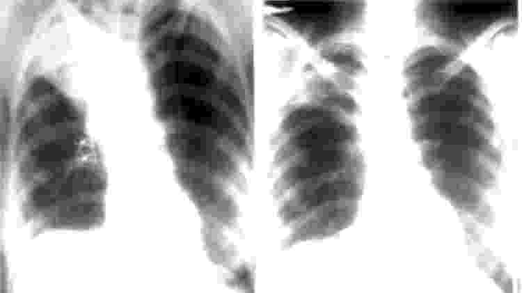 Raio-x de pulmão após inalação acidental de camisinha - Reprodução/C. L. Arya, R. Gupta, V. Arora/Semantic Scholar  - Reprodução/C. L. Arya, R. Gupta, V. Arora/Semantic Scholar 