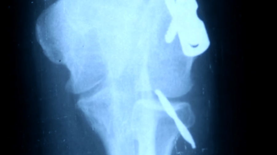Raio-x mostrou broca de 5 centímetros no braço da paciente, em 2018 - Reprodução/TV Anhanguera