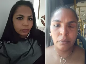 'Vi sangue e percebi que tomei tiro': ela perdeu o olho após disparo de PM