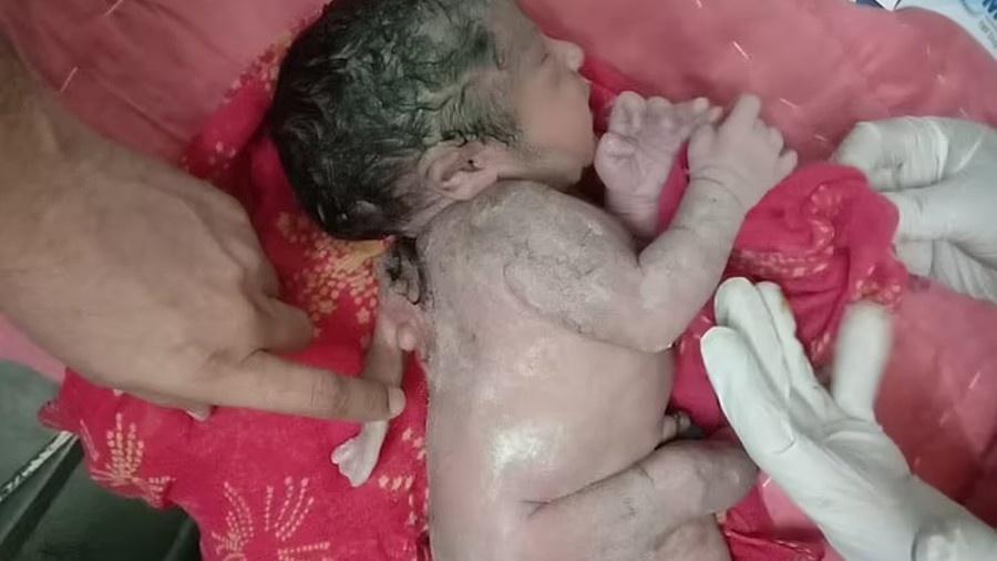 O bebê nasceu com terceira mão nas costas  - Reprodução/Facebook