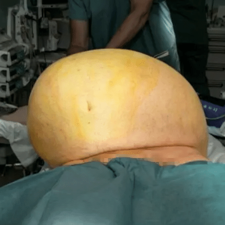 Tumor retirado da barriga de Thomas Kraut tinha mais de 50 cm