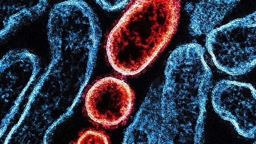 NIH-NIAID/Image Point FR/BSIP/Universal Images Group via Getty Images