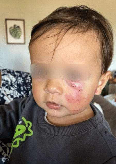 Bebê com hematomas no rosto após levar mordida em creche de Criciúma