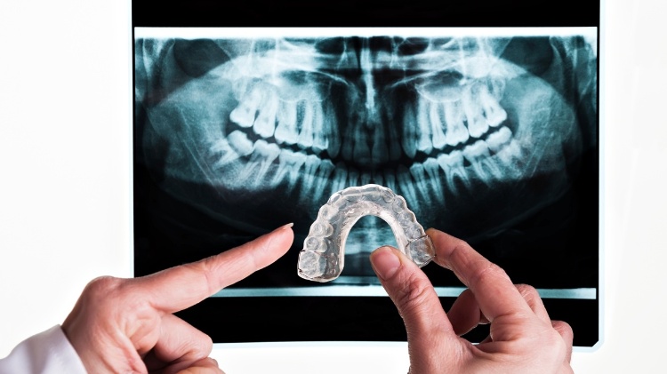Raio-X mostra as consequências do bruxismo nos dentes de um paciente