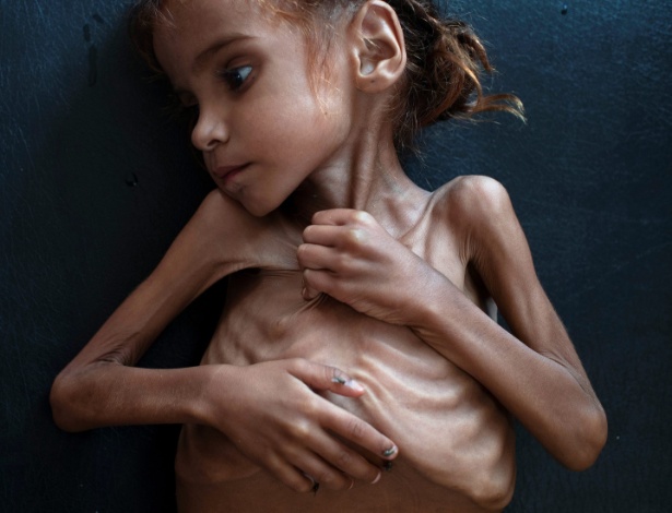 Amal Hussain, 7, que sofria de desnutrição aguda severa, era cuidada em uma clínica móvel administrada pela Unicef em Aslam, Iêmen - TYLER HICKS/NYT