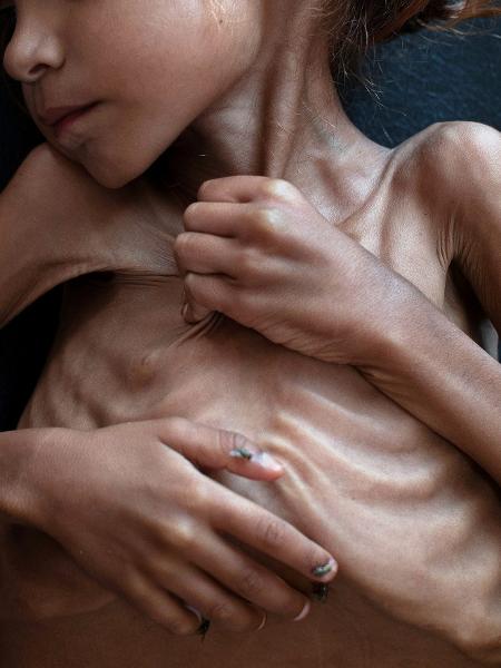 Amal Hussain, 7, que sofria de desnutrição aguda severa, era cuidada em uma clínica móvel administrada pela Unicef em Aslam, Iêmen - TYLER HICKS/NYT