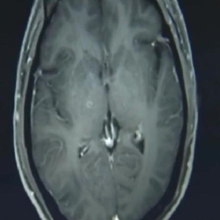 Exame mostrou cisticercos no cérebro - Reprodução/AsiaWire/ZJU 1st Hospital