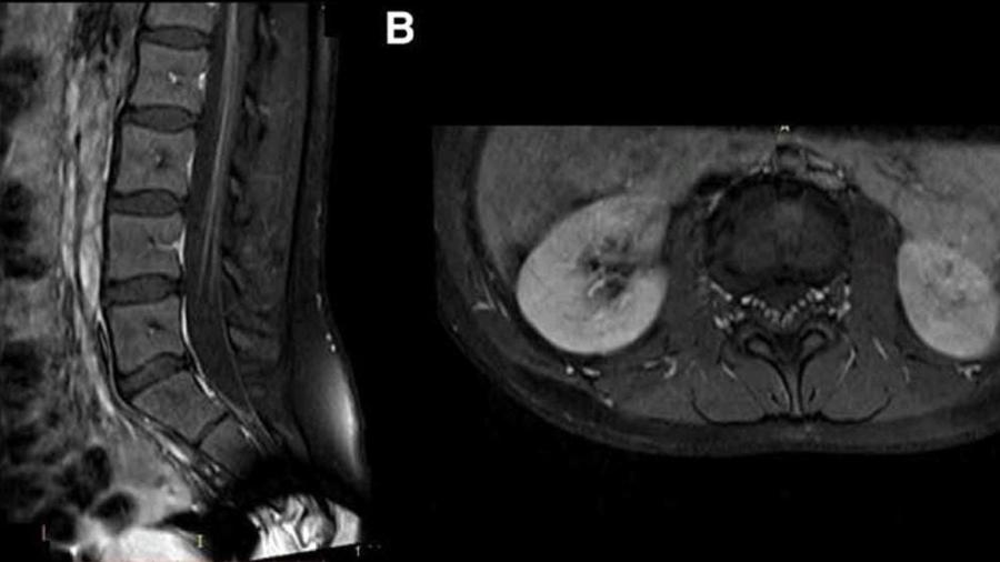 Imagens do estudo que permitiram associar a infecção pelo novo coronavírus à Síndrome de Guillain-Barré - Divulgação