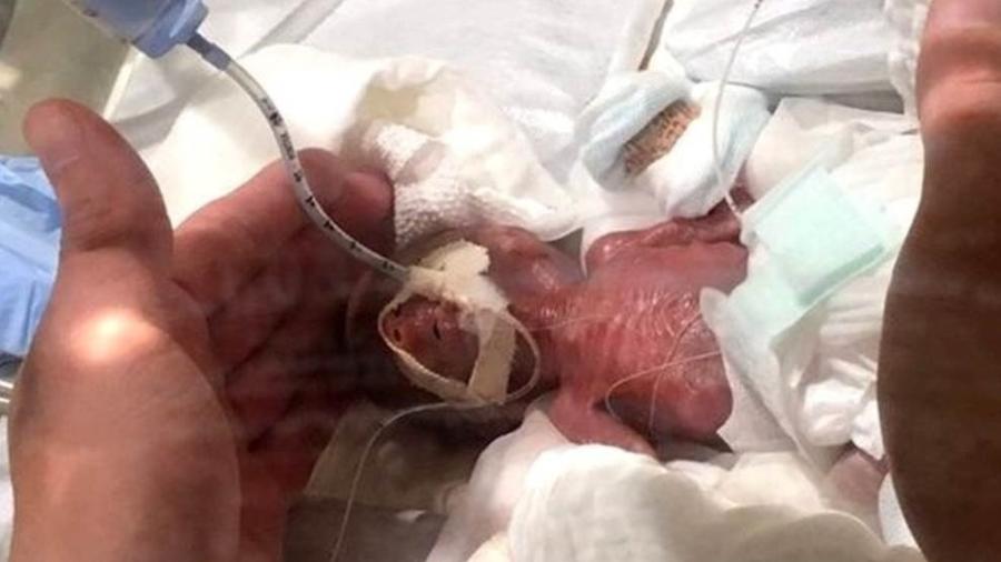 O bebê cinco dias após nascer... - spital Universitário Keio/BBC