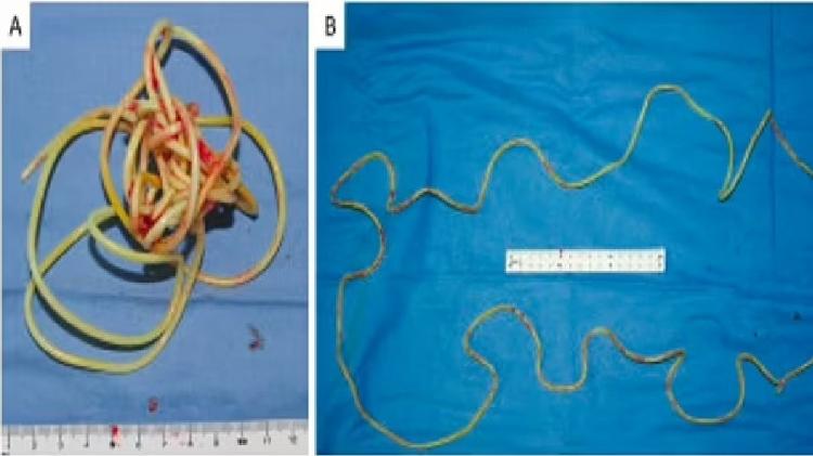 2-metre string removed from Japanese man's bladder - Press Release/Urology Case Reports - Press Release/Urology Case Reports