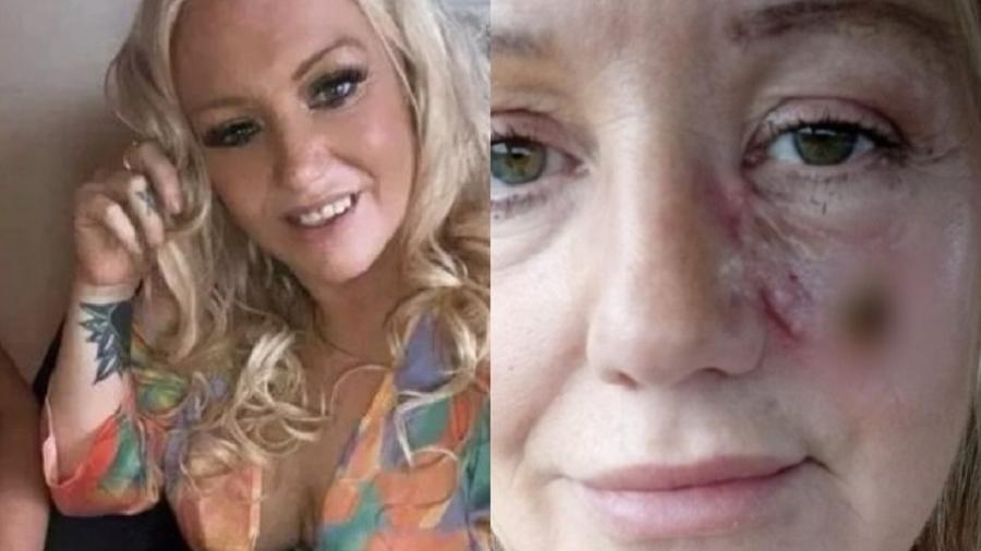Irmã de Kelly Allen compartilhou foto da evolução da cicatriz dela em página nas redes sociais