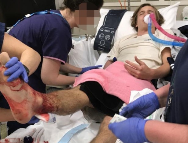Sam Kanizay teve a perna atacada pelo que se acredita ser piolhos do mar quando entrou no mar - Reprodução/Facebook