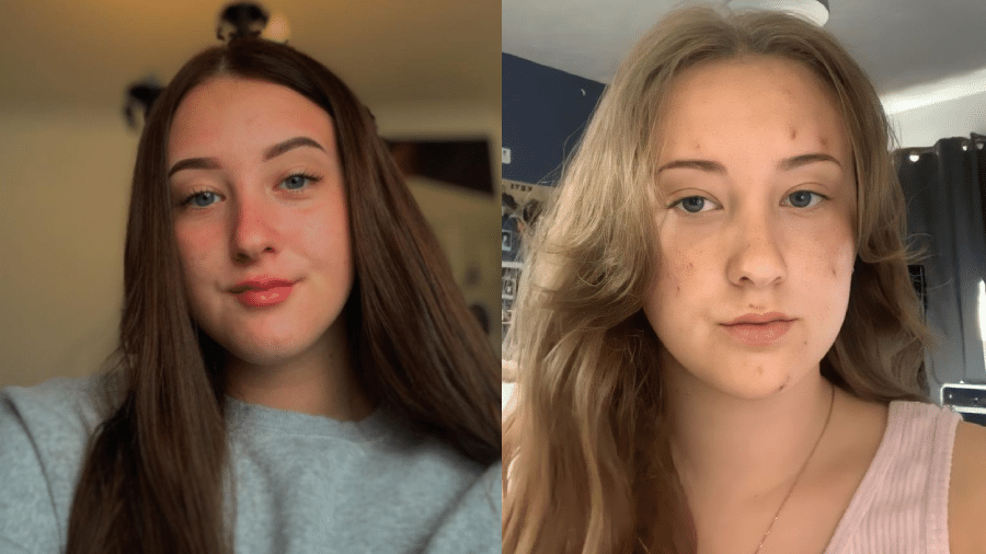 Kirsten Cowell, de 19 anos, teve o rosto coberto por feridas em um caso de doença rara de pele - Arquivo pessoal/Kennedy News and Media