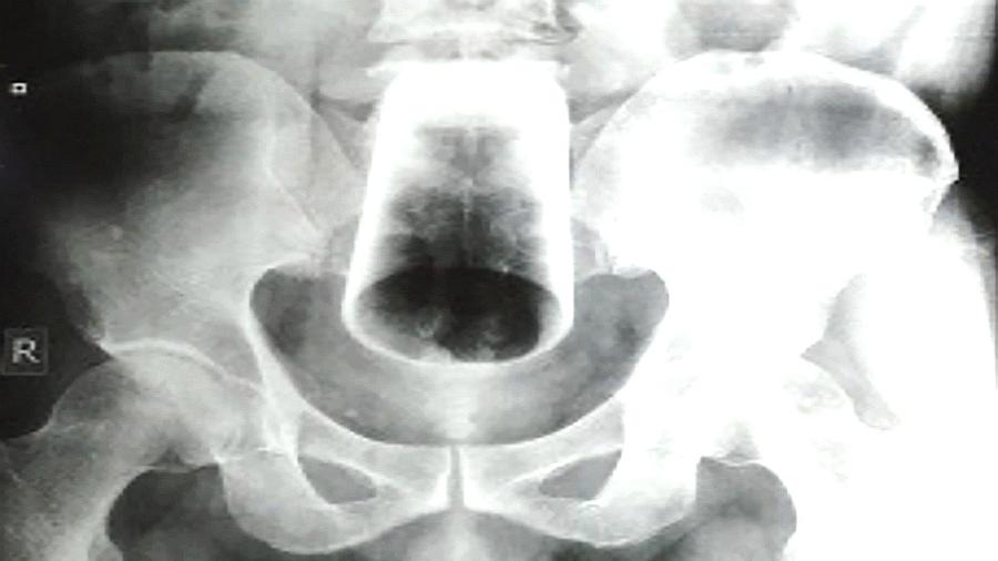 Homem precisou de cirurgia no intestino para remover copo de 12 cm - Reprodução/Journal of Nepal Medical Association