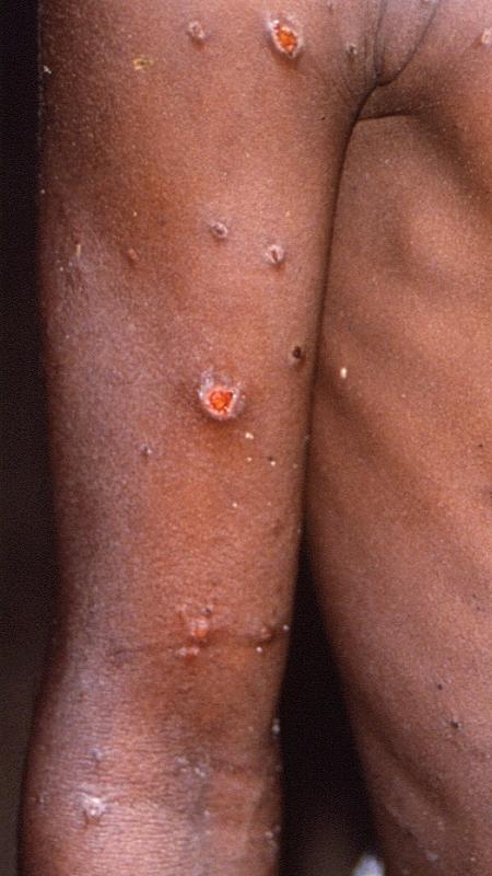 Paciente com varíola dos macacos, no Congo, em foto de arquivo tirada durate uma explosão de casos da doença entre 1996 e 1997   - Brian W.J. Mahy/ via Reuters - Brian W.J. Mahy/ via Reuters