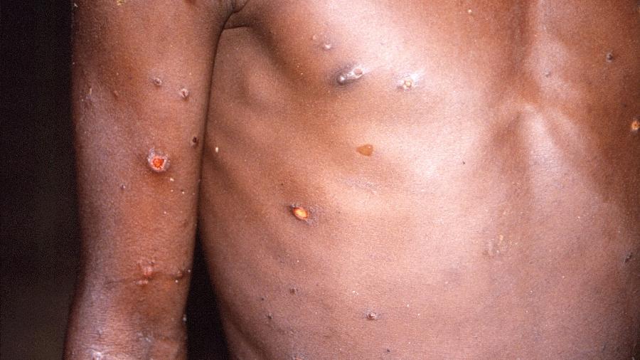 Paciente com varíola dos macacos, no Congo, em foto de arquivo tirada durate uma explosão de casos da doença entre 1996 e 1997 - Brian W.J. Mahy/ via Reuters