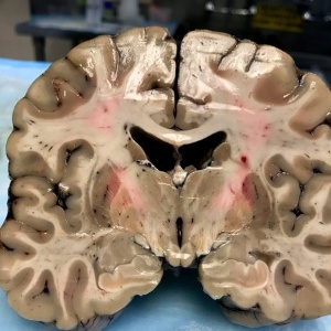 Apesar de aparência externa saudável cérebro de Hernandez estava profundamente danificado por Encefalopatia Traumática Crônica - Boston University/BBC