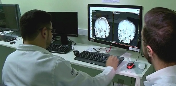 Como médicos gaúchos usaram impressora 3D para reconstruir crânio por R$ 45