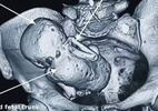 Em caso raríssimo, mulher descobre gestar um 'bebê de pedra' e é operada