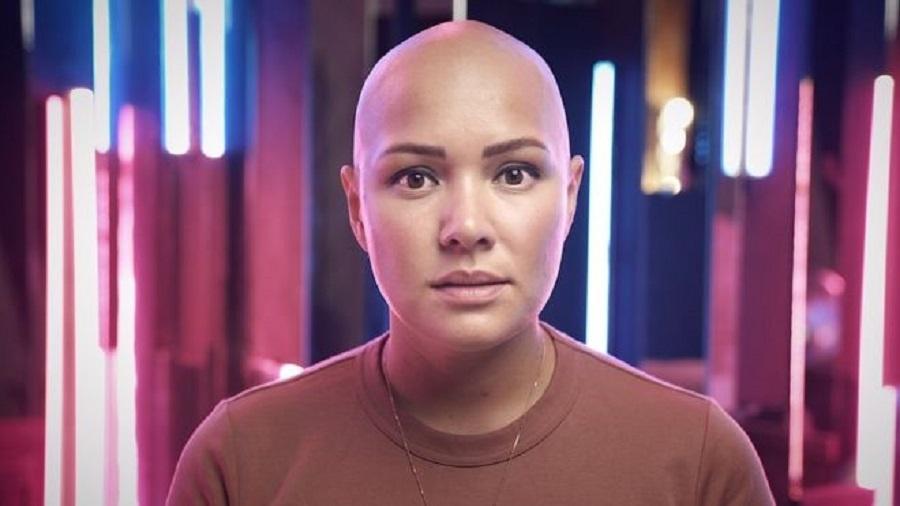 Liliya diz que sofreu bullying por ter alopecia areata, uma condição que causa perda de cabelo - BBC