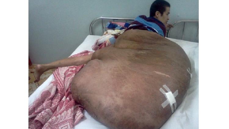 Vietnamita de 31 anos passou por cirurgia de 12 horas para retirada de tumor, mas morreu um ano depois