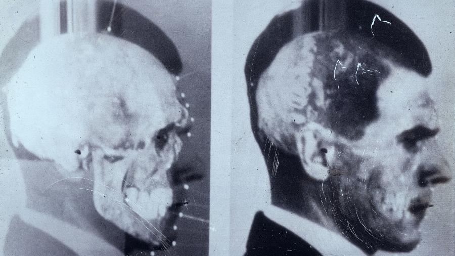 Cientistas alemães apostaram em técnica inovadora de sobrepor imagens para confirmar que crânio exumado em Embu era de Josef Mengele - Cortesia/Maja Helmer