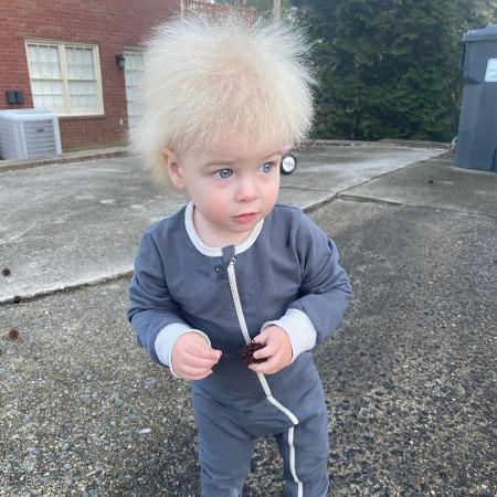 Bebê tem síndrome do cabelo impenteável, uma condição rara e hereditária - Reprodução/Instagram