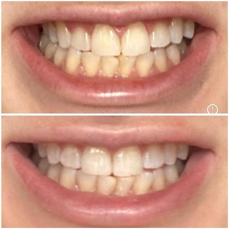 Antes e depois de usar a caneta branqueadora Luminous White da Colgate Antes e depois de usar a caneta branqueadora Luminous White da Colgate