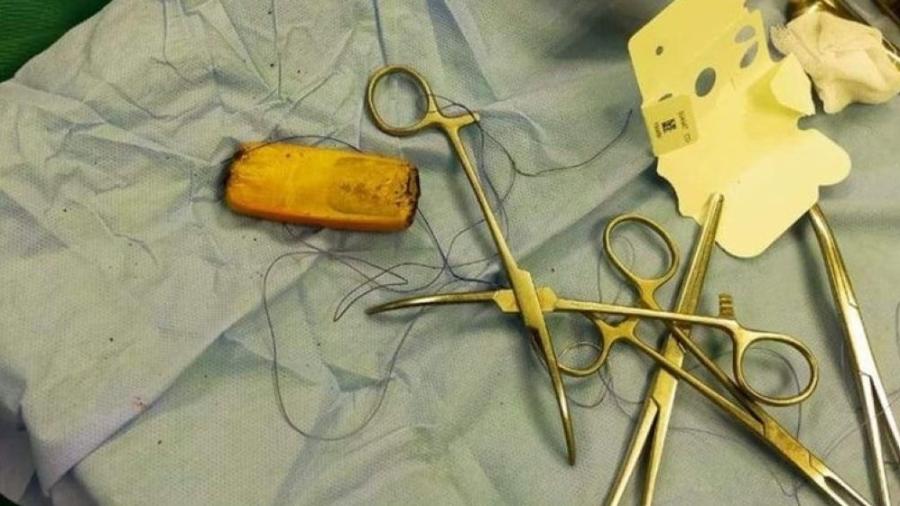 Aparelho celular foi retirado do estômago do paciente - Divulgação/ Hospital Universitário de Aswan