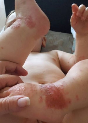 Amy Stinton postou foto do filho Oliver, que teria contraído herpes após beijo - Arquivo pessoal