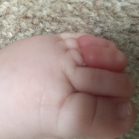 Orla tinha três meses quando foi vítima da síndrome do torniquete - Arquivo pessoal/Gemma Fraser - Arquivo pessoal/Gemma Fraser