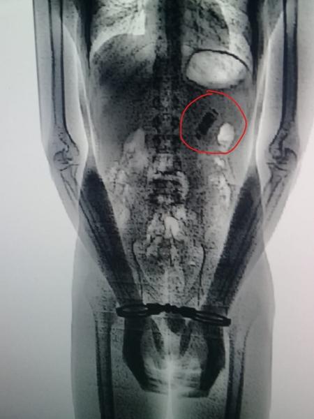 Homem é flagrado com celular dentro do estômago no RN - Seap/Divulgação