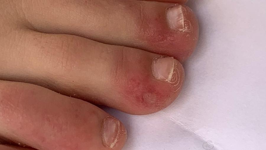 "Dedos de covid" foi um dos sintomas observados - COVID-piel study
