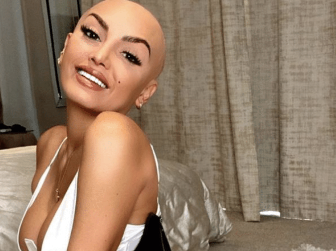 Alopecia: 'mostrar minha careca nas redes é libertador', diz influenciadora