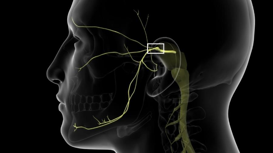 Neuralgia do trigêmeo é um quadro de dor associado a um nervo, o trigêmeo