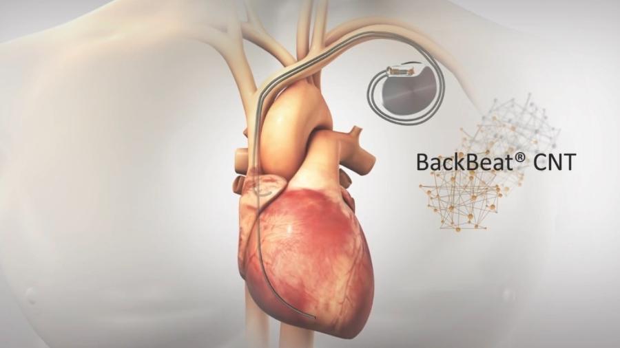 Backbeat CNT, aparelho de marca-passo que promete ajudar pacientes com hipertensão - Reprodução/Orchestra BioMed