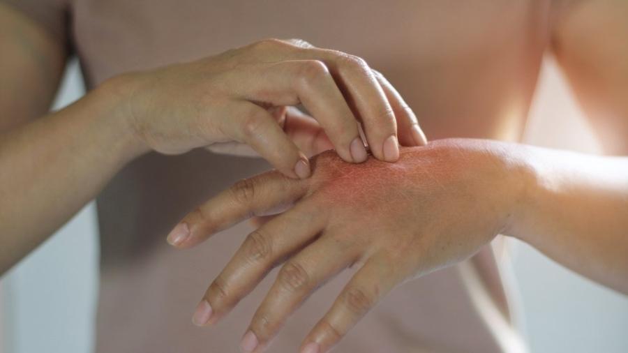 Pessoas com dermatilomania podem beliscar ou arranhar manchas, sardas, marcas ou cicatrizes para "suavizar" ou "ajeitá-las" - Getty Images