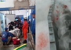 RO: Trabalhador fica com a perna presa em triturador de gelo; veja - João Cordeiro/CBMRO