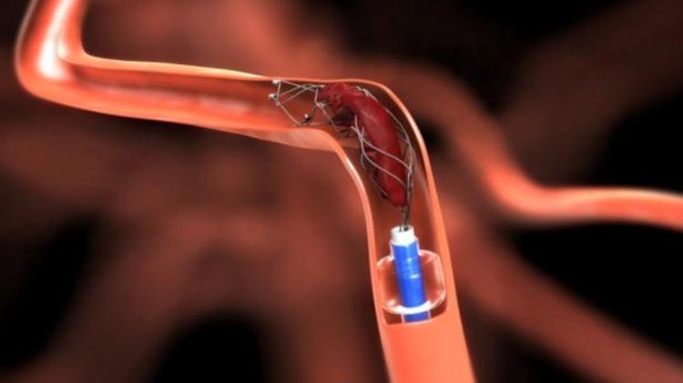 Ilustração mostra a trombectomia mecânica: stent retira o coágulo de um vaso cerebral