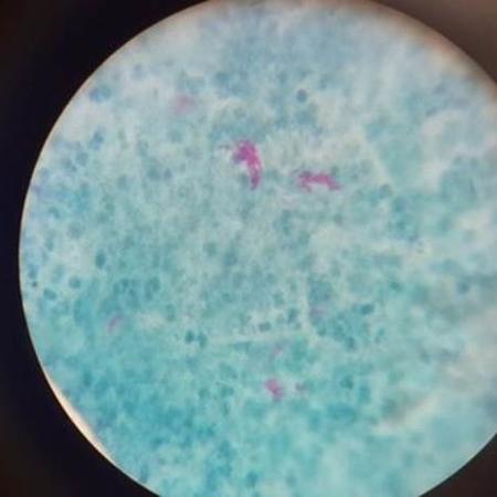 Imagem microscópica mostra a Mycobacteruim laprae; pesquisadores brasileiros detectaram existência de bactérias resistentes ao tratamento-padrão em maior proporção do que apontado pela OMS - Getty Images