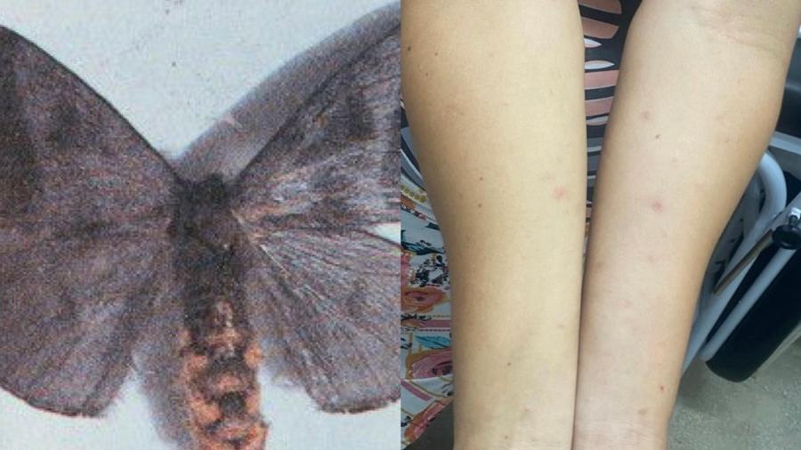 Nota técnica concluiu que cerdas de mariposa provocaram as lesões na pele de moradores em PE - Sociedade Brasileira de Dermatologia
