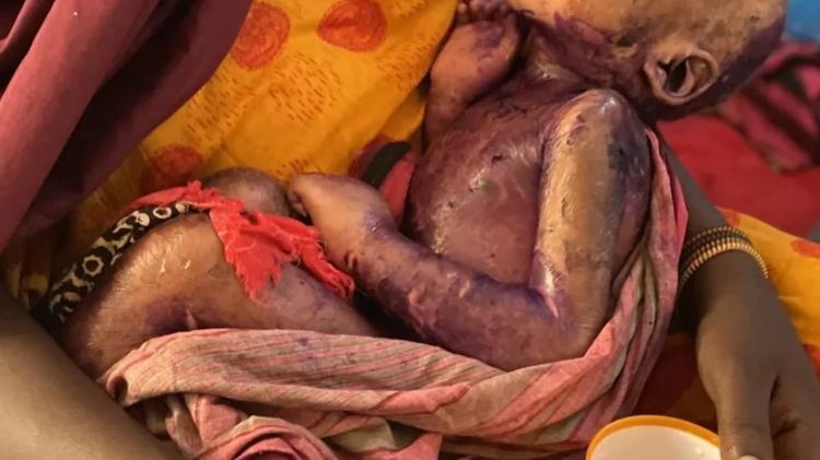 Cases of starvation can cause severe damage to the skin that swells and breaks down - BBC/ ED HABERSHON - BBC/ ED HABERSHON