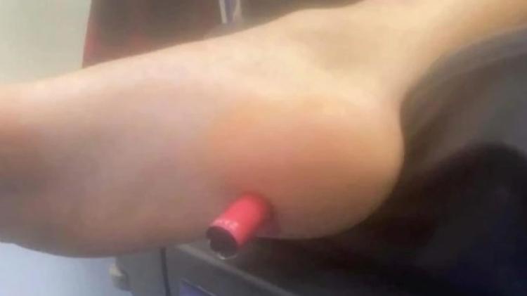 13-year-old teenager who stepped into electronic cigarette survived amputation - Reproduction/ The Sun - Reproduction/ The Sun