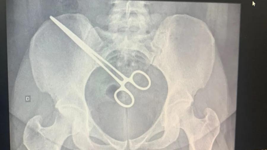Pinça médica, objeto que se assemelha a uma tesoura, foi encontrado dentro da mulher meses após cirurgia