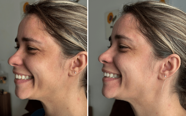 Antes e depois da primeira aplicação do bastão facial Ricca Antes e depois da primeira aplicação do bastão facial Ricca