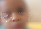 Menina de 2 anos gruda olho com supercola e espera 5 dias por cirurgia - Arquivo Pessoal